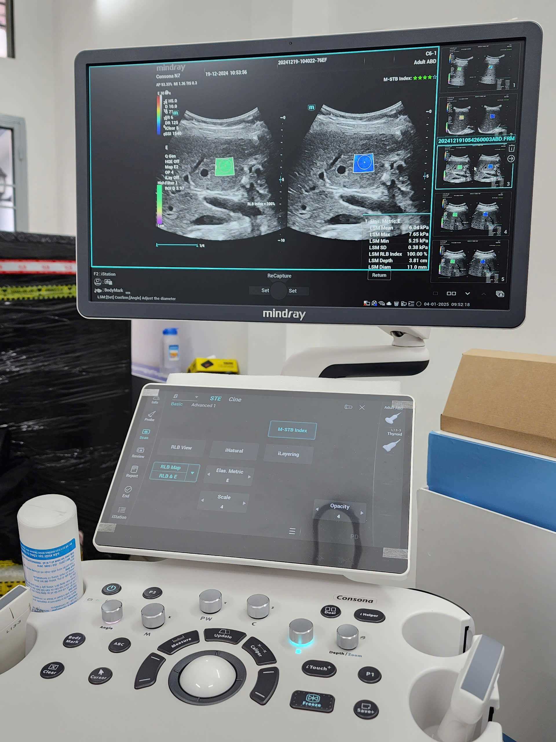 Máy siêu âm Mindray Consona N7 ứng dụng siêu âm đàn hồi mô gan định lượng.
