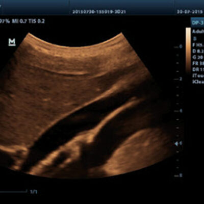 Máy siêu âm xách tay 2D Mindray DP10