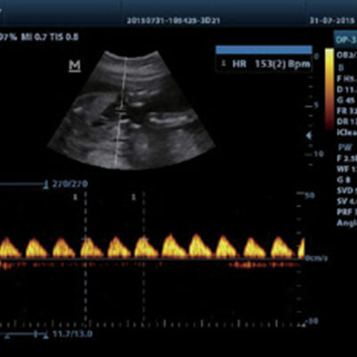Hình ảnh siêu âm thực tế trên máy Mindray DP10
