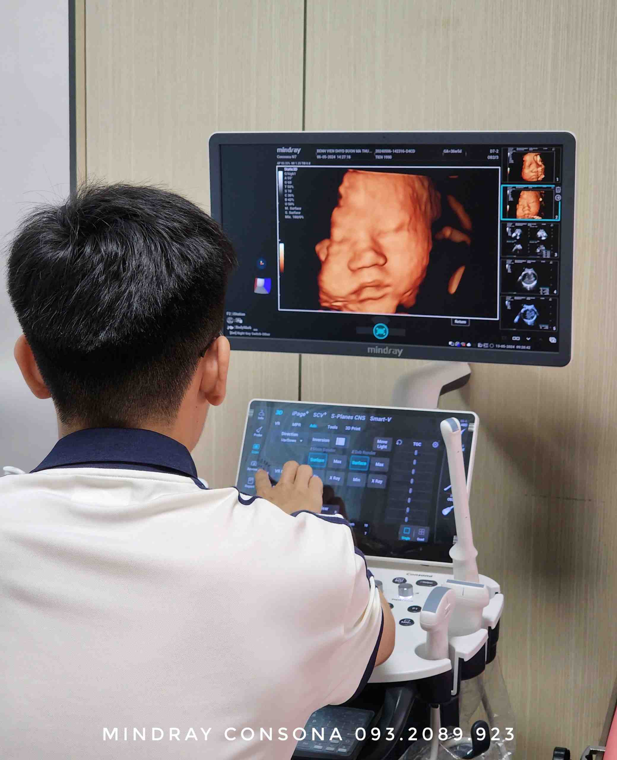 Siêu am dựng mặt thai nhi 5D trên Mindray Consona