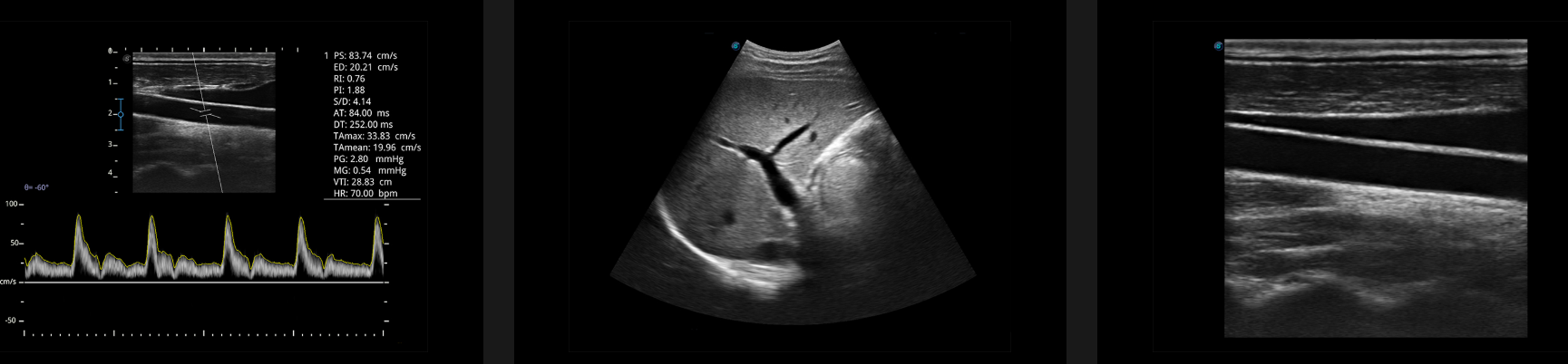Hình ảnh siêu âm 2d đen trắng sắc nét trên máy siêu âm xách tay Sonoscape E1.