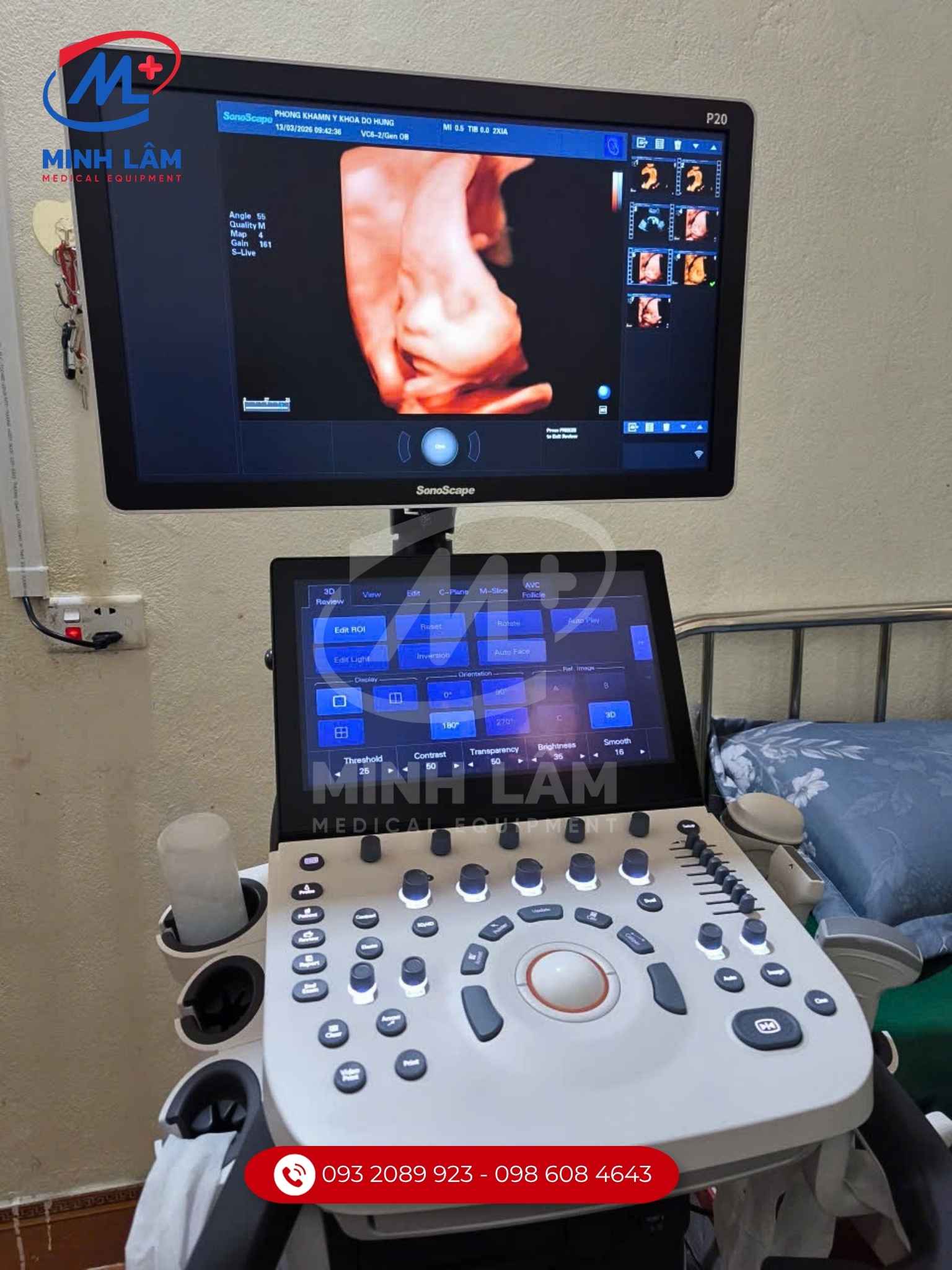Máy siêu âm 5D SonoScape P20 dựng hình thai nhi nét đẹp, tiêu chuẩn FDA Mỹ.