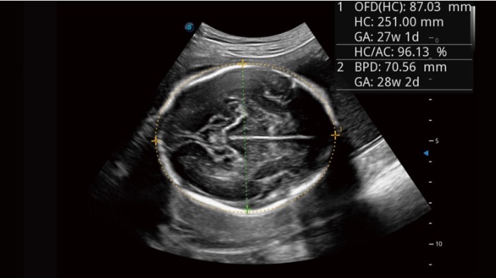 S-Fetus ứng dụng trí tuệ AI đối với siêu âm sản khoa.
