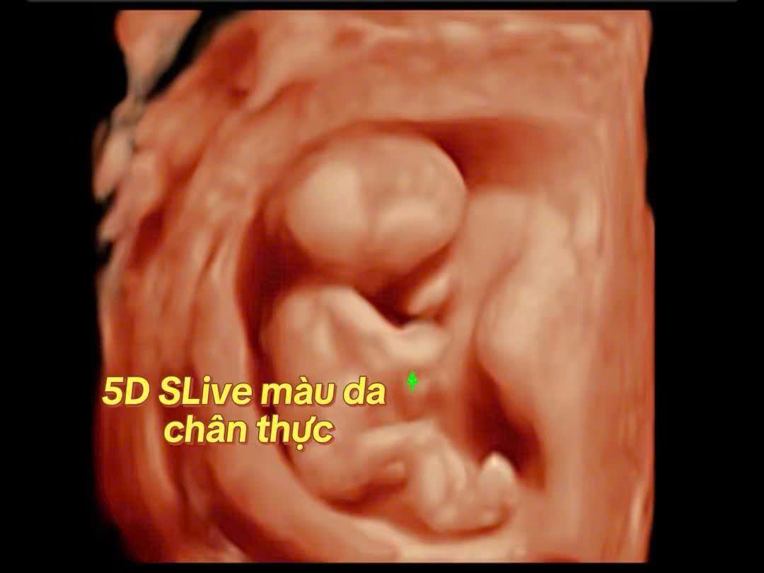 Siêu âm 5D khảo sát hình thái học thai nhi.