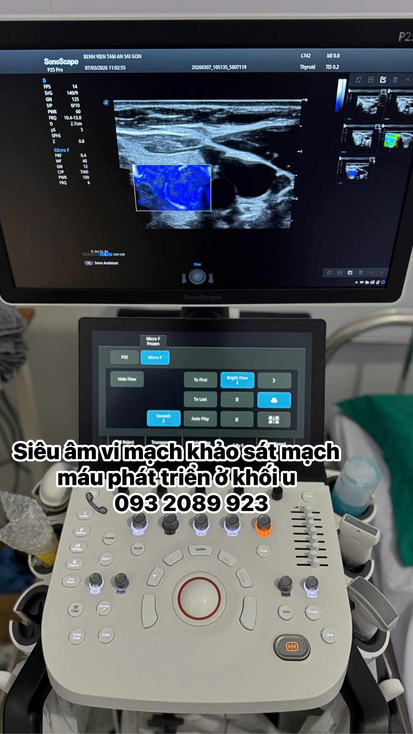 Siêu âm vi mạch trên Sonoscape P25 Pro quan sát rõ nét những mạch máu nhỏ, dòng chảy chậm.