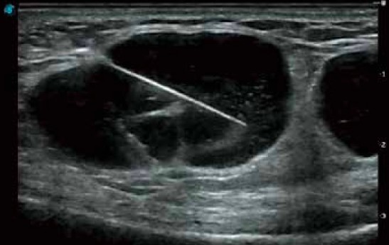 Tính năng Vis-Needle tiêm chọc hút dưới hướng dẫn siêu âm.