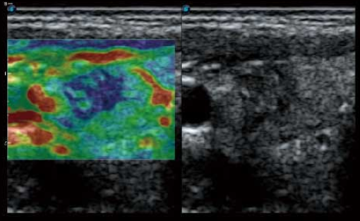 Hình ảnh bảng đồ màu xác định độ cứng mềm của vùng mô bằng tính năng Elastography.