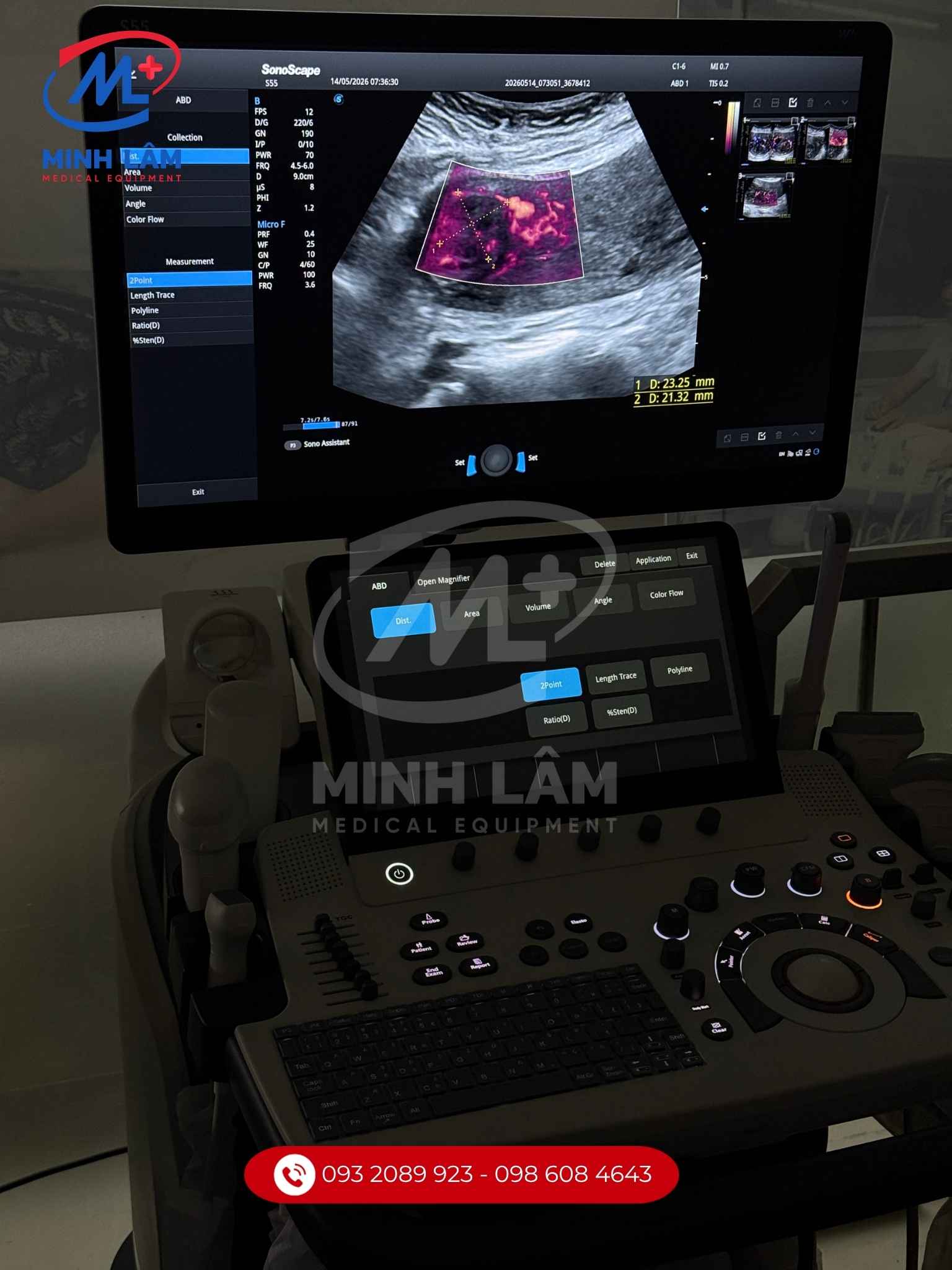 Micro F - Siêu âm vi mạch dễ dàng khảo sát các mạch máu nhỏ, sự phân nhánh tại các khối u, nang.