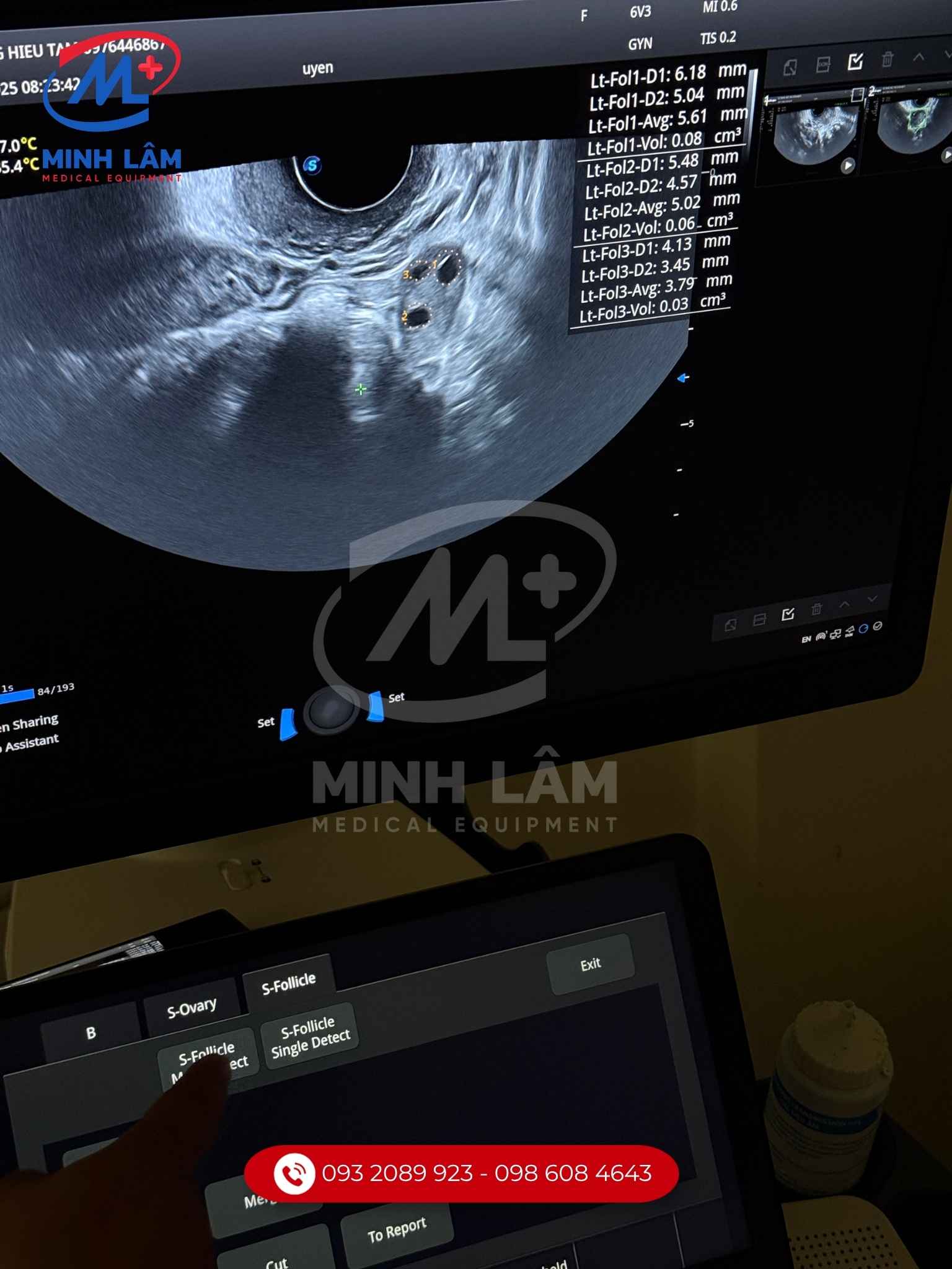 Tự động đếm nang trứng bằng trí tuệ siêu âm AI S-Ovary, S-Uterus.