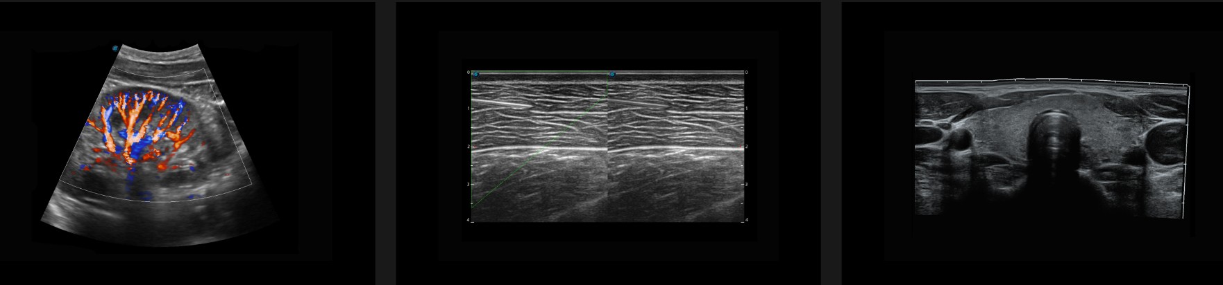 Hình ảnh siêu âm trên máy Sonoscape S22 đen trắng, doppler màu.