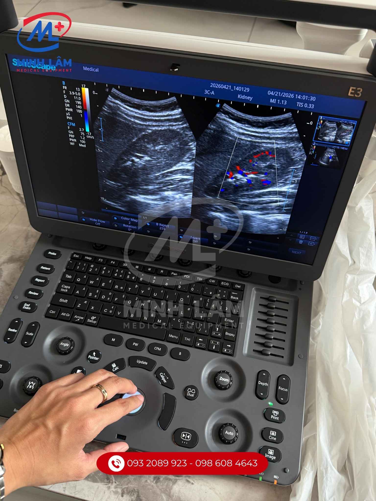 Máy siêu âm Sonoscape E3 - Cấu hình chuyên tim, 3 cổng cắm đầu dò Máy siêu âm Sonoscape E3 - Cấu hình chuyên tim, 3 cổng cắm đầu dò