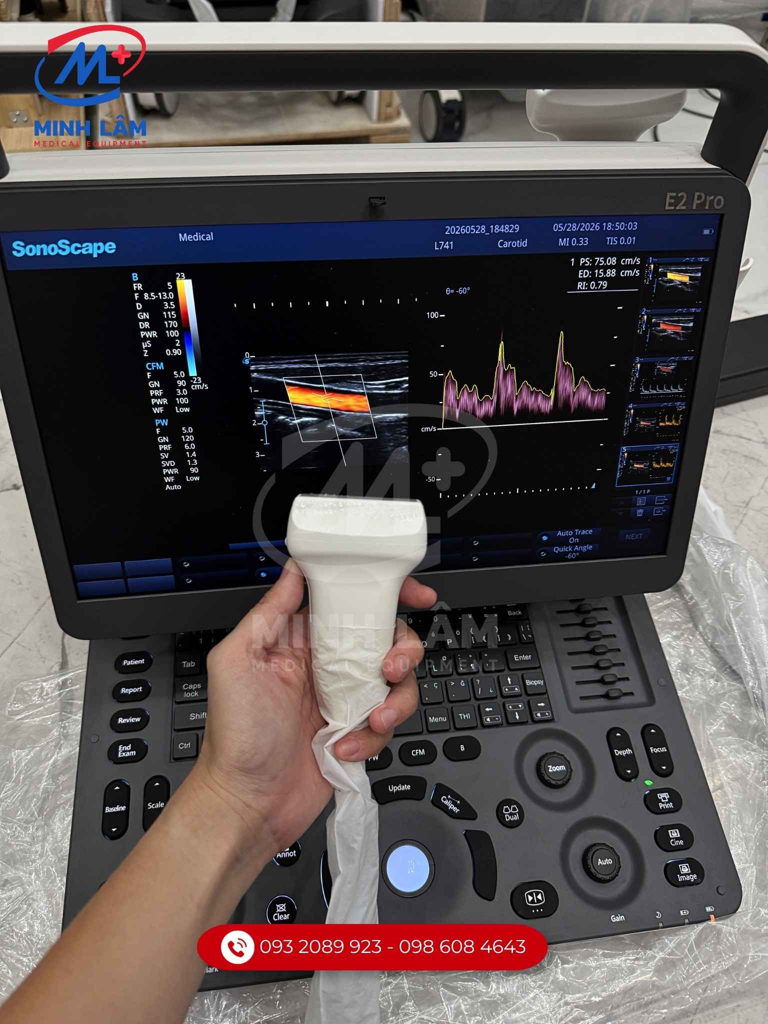 Siêu âm mạch máu doppler màu.